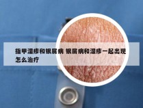 指甲湿疹和银屑病 银屑病和湿疹一起出现 怎么治疗