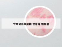 甘草可治银屑病 甘草锌 银屑病