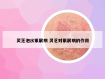 灵芝泡水银屑病 灵芝对银屑病的作用