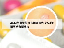 2023年有希望攻克银屑病吗 2021年银屑病有望根治
