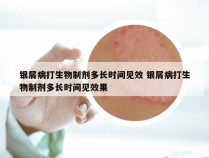 银屑病打生物制剂多长时间见效 银屑病打生物制剂多长时间见效果