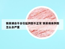 银屑病会不会引起例假不正常 银屑病来例假怎么会严重