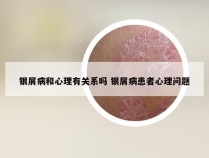 银屑病和心理有关系吗 银屑病患者心理问题