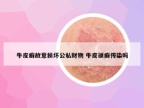 牛皮癣故意损坏公私财物 牛皮顽癣传染吗