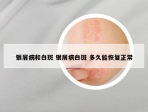 银屑病和白斑 银屑病白斑 多久能恢复正常