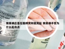 银屑病总是在胳膊窝和腿窝起 银屑病手臂为什么起白点