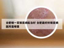 合肥哪一家银屑病能治好 合肥最好的银屑病医院是哪里