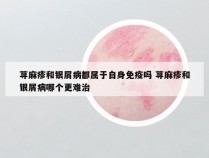 荨麻疹和银屑病都属于自身免疫吗 荨麻疹和银屑病哪个更难治