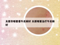 太原市哪里看牛皮癣好 太原哪里治疗牛皮癣好