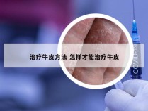 治疗牛皮方法 怎样才能治疗牛皮