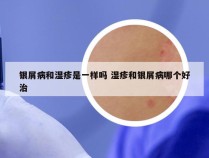 银屑病和湿疹是一样吗 湿疹和银屑病哪个好治