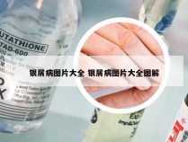 银屑病图片大全 银屑病图片大全图解