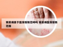 银屑病属于医保报销范畴吗 银屑病医保报销范围