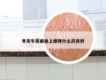 冬天牛皮癣身上痒擦什么药膏好
