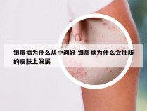 银屑病为什么从中间好 银屑病为什么会往新的皮肤上发展