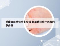 重度银屑病住院多少钱 银屑病住院一天大约多少钱