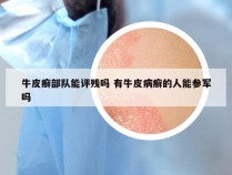 牛皮癣部队能评残吗 有牛皮病癣的人能参军吗