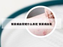 银屑病血常规什么表现 银屑病血象