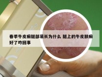 春季牛皮癣腿部易长为什么 腿上的牛皮肤癣好了咋回事