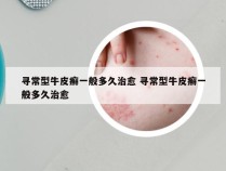 寻常型牛皮癣一般多久治愈 寻常型牛皮癣一般多久治愈