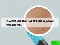 吃中药治好银屑病 吃中药治银屑病,越来越胖是后遗症吗