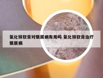 氧化锌软膏对银屑病有用吗 氧化锌软膏治疗银屑病