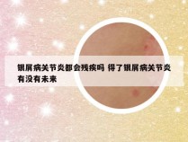 银屑病关节炎都会残疾吗 得了银屑病关节炎有没有未来