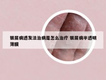 银屑病透发法治病是怎么治疗 银屑病半透明薄膜