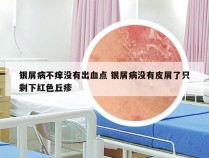 银屑病不痒没有出血点 银屑病没有皮屑了只剩下红色丘疹