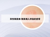 异性银屑病 银屑病人伴侣的感受