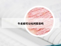 牛皮癣可以吃阿胶膏吗