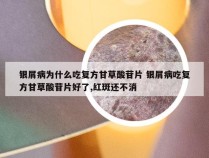 银屑病为什么吃复方甘草酸苷片 银屑病吃复方甘草酸苷片好了,红斑还不消