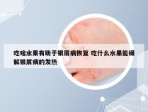 吃啥水果有助于银屑病恢复 吃什么水果能缓解银屑病的发热