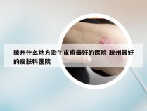 滕州什么地方治牛皮癣最好的医院 滕州最好的皮肤科医院