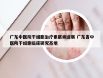 广东中医院干细胞治疗银屑病进展 广东省中医院干细胞临床研究基地