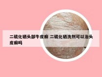 二硫化硒头部牛皮癣 二硫化硒洗剂可以治头皮癣吗