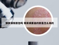 银屑病有脓包吗 银屑病里面的脓是怎么来的