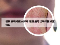 银屑病喝柠檬水好吗 银屑病可以喝柠檬蜂蜜水吗