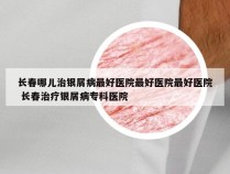 长春哪儿治银屑病最好医院最好医院最好医院 长春治疗银屑病专科医院