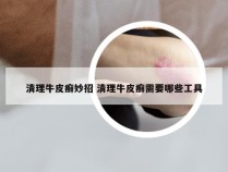 清理牛皮癣妙招 清理牛皮癣需要哪些工具