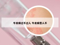 牛皮癣过不过人 牛皮癣惹人不