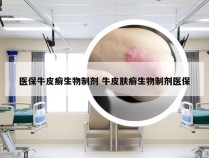 医保牛皮癣生物制剂 牛皮肤癣生物制剂医保