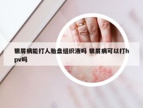 银屑病能打人胎盘组织液吗 银屑病可以打hpv吗