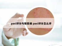 pasi评分与银屑病 pasi评分怎么评