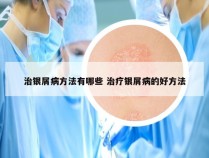治银屑病方法有哪些 治疗银屑病的好方法