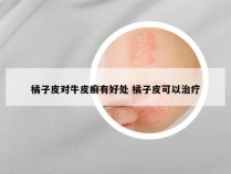 橘子皮对牛皮癣有好处 橘子皮可以治疗