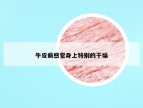 牛皮癣感觉身上特别的干燥