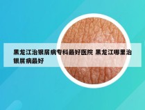 黑龙江治银屑病专科最好医院 黑龙江哪里治银屑病最好