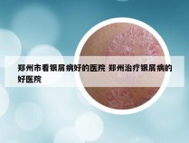 郑州市看银屑病好的医院 郑州治疗银屑病的好医院