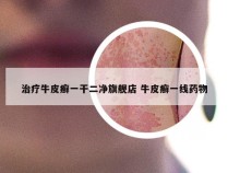 治疗牛皮癣一干二净旗舰店 牛皮癣一线药物
